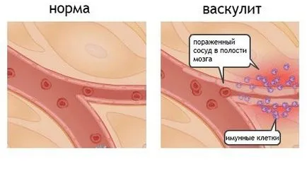 Vasculitis - azaz, az okok, tünetek és a kezelés (tünetek) Vasculitis - azaz, az okok, tünetek és a kezelés