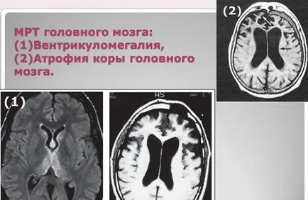 Ventriculomegalia a magzat és az újszülött gyermek, mi az, okok, kezelés következményeit (ventriculomegalia gyermek Dr. Komarovsky) Ventriculomegalia a magzat és az újszülött gyermek, mi az, okok, kezelés, következményei