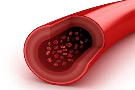 Vasculitis áttekintést a betegség tények