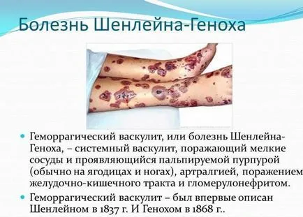 Vasculitis diagnózis, tünetei és kezelése népi jogorvoslat (tünetek) Vasculitis diagnózis, tünetei és kezelése népi jogorvoslati