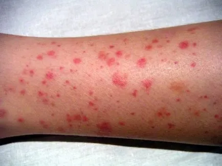 Vasculitis - kezelése népi jogorvoslat a lábakon (kezelés) Vasculitis - kezelése népi jogorvoslat lábra
