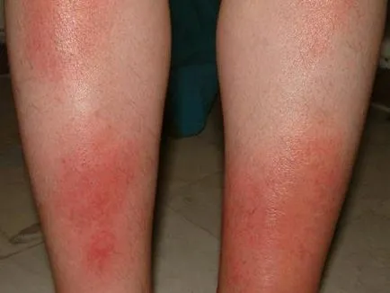 Vasculitis - mi ez, és okoz tüneteket vasculitis