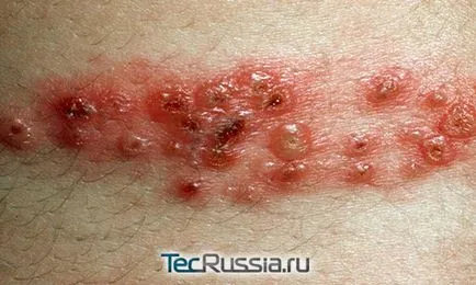 Típusai megfosztja a bőrt, a kezek és emberi test - fotó, tünetek és kezelések (gyógyszerek) Típusai megfosztja a bőrt, a kezek és emberi test - fotó, tünetek és kezelés