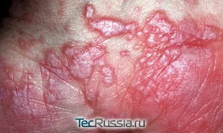 Típusai megfosztja a bőrt, a kezek és emberi test - fotó, tünetei és kezelése (viszketés) Típusai megfosztja a bőrt, a kezek és emberi test - fotó, tünetek és kezelés