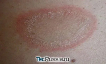 Típusai megfosztja a bőrt, a kezek és emberi test - fotó, tünetei és kezelése (kezelés) Típusai megfosztja a bőrt, a kezek és az emberi test - fotó, tünetek és kezelés