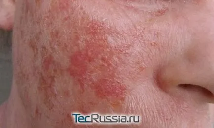 Típusai megfosztja a bőrt, a kezek és emberi test - fotó, tünetei és kezelése (összesen) Típusai megfosztja a bőrt, a kezek és emberi test - fotó, tünetek és kezelés