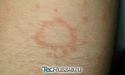Típusai megfosztja a bőrt, a kezek és emberi test - fotó, tünetei és kezelése (is) Típusai megfosztja a bőrt, a kezek és az emberi test - fotó, tünetek és kezelés
