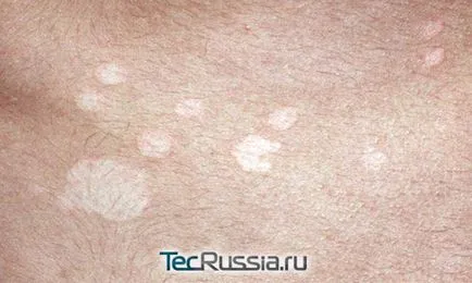 Típusai megfosztja a bőrt, a kezek és emberi test - fotó, tünetei és kezelése (is) Típusai megfosztja a bőrt, a kezek és emberi test - fotó, tünetek és kezelés