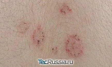 Típusai megfosztja a bőrt, a kezek és emberi test - fotó, tünetei és kezelése (talán) Típusai megfosztja a bőrt, a kezek és emberi test - fotó, tünetek és kezelés