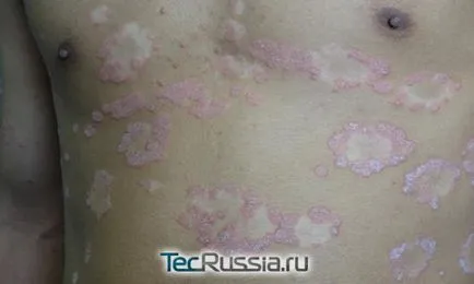 Típusai megfosztja a bőrt, a kezek és emberi test - fotó, tünetei és kezelése (talán) Típusai megfosztja a bőrt, a kezek és emberi test - fotó, tünetek és kezelés