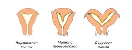 Méhen belüli válaszfal diagnózis, a terhesség alatt, az ő boncolás sebészet