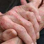 Mindent a ekcéma és annak kezelése