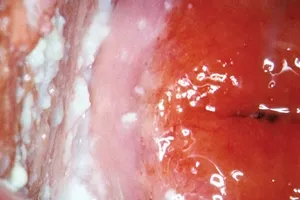 Chlamydia mi ez, hogyan kell kezelni antibiotikummal, és milyen következményei vannak a fertőzés