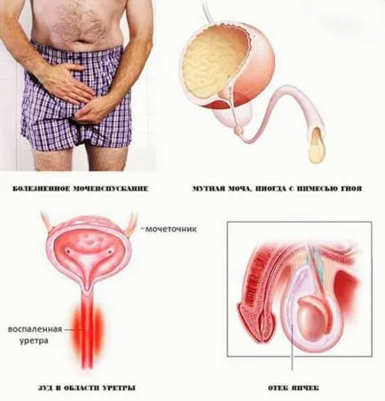Chlamydia, hogy van, a típusok, okok, tünetek, kezelés, megelőzés (faj) Chlamydia, hogy van, a típusok, okok, tünetek, kezelés, megelőzés