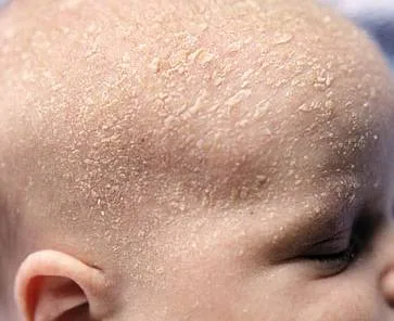 Minden dermatitis gyermekek és kezelésük