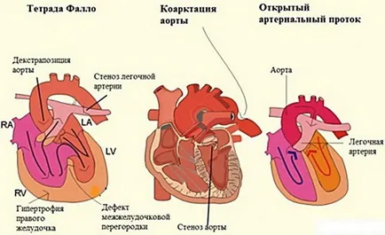 Veleszületett szívbetegségek és azok okait, rendelés, panaszok, diagnózis, kezelés