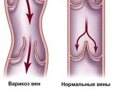 Tünetei és jelei vénákban, lehetséges patológia, megelőzés (tünetek) Tünetei és jelei vénákban, lehetséges betegségek, megelőzése
