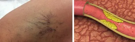 Tünetei és jelei vénákban, lehetséges Pathology, megelőzés (betegség) Tünetei és jelei vénákban, lehetséges betegségek, megelőzése
