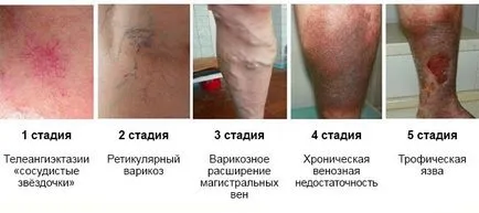 Tünetei és jelei vénákban, lehetséges patológia, megelőzés (érbetegség a lábak) Tünetei és jelei vénákban, lehetséges betegségek, megelőzése