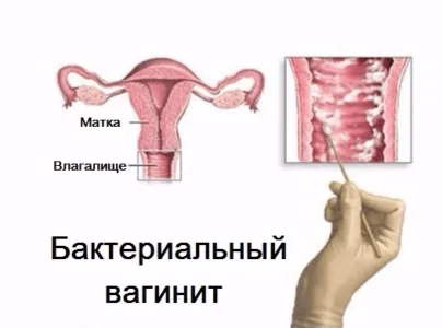 Viszketés és égő érzés a hüvelyben viszket, amiért a vagina okoz bőrpírt, irritációt, mint a gyógyítás