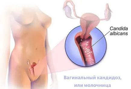 Viszketés menopauza a hüvelyben kezelést népi jogorvoslat
