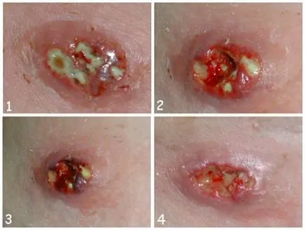 Staphylococcus aureus gyermekeknél a tünetek, mértékét, hatásait S. aureus