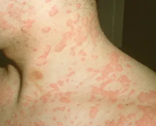 Allergiás bőrtünetek (foltokat) és típus (allergiás megnyilvánulása az elszíneződés) Allergiás bőrtünetek (foltok) és típusai