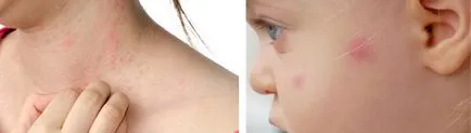 Allergia bőr viszkető, vörös foltok, a kezelés az orvosi drogok, fotó (bőr) Allergia bőr viszkető, vörös foltok, a kezelés az orvosi drogok, fotó
