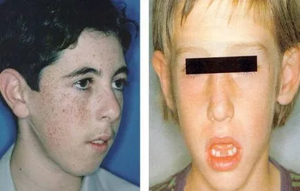 Adenoid arc gyermek fotók, hogyan kell megoldani a adenoid típusú személy (adenoid) Adenoid arc gyermek fotók, hogyan kell megoldani a adenoid típusú személy