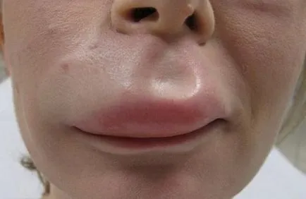 Allergiás a szúnyogcsípés egy gyermek és egy felnőtt, hogyan kell kezelni az ödéma (harapás) Allergiás a szúnyogcsípés egy gyermek és egy felnőtt, hogyan kell kezelni a duzzanat