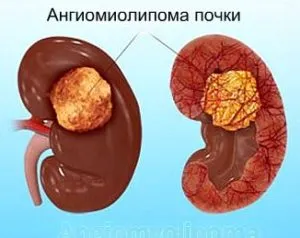 vese angiomyolipoma - mi ez az ok és a betegség tüneteit