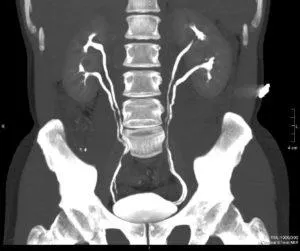vese angiomyolipoma - mi ez az ok és a betegség tüneteit