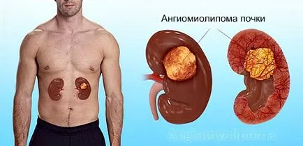 vese angiomyolipoma - egy fotó a rák, a kezelés és a prognózis