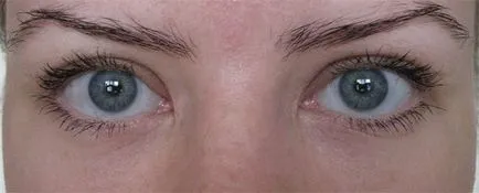 Felső szemhéj szemhéjplasztika eljárás, az árak, előtt és után, video (árak) Felső szemhéj szemhéjplasztika eljárás, az árak, előtti és utáni képek, videók