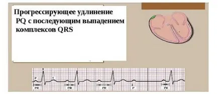 Szív blokk, mi ez, tünetei és kezelése (blokád) Szív blokk, mi ez, tünetei és kezelése