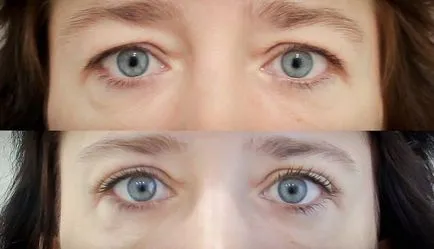 Felső szemhéj szemhéjplasztika eljárás, az árak, előtt és után, video (fotó) Felső szemhéj szemhéjplasztika eljárás, az árak, előtti és utáni képek, videók