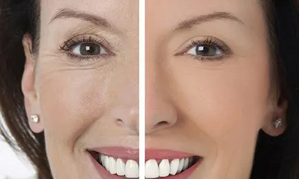 Blepharoplasty felső szemhéj felépülési időszak (felső) Blepharoplasty felső szemhéj felépülési időszakot