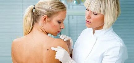 Ceboreyny keratosis (ctarcheskie szemölcsök) (oka seborrheás keratosis) Ceboreyny keratosis (ctarcheskie szemölcsök)