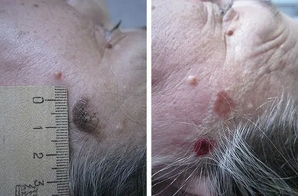 Ceboreyny keratosis (ctarcheskie szemölcsök) (oka seborrheás keratosis) Ceboreyny keratosis (ctarcheskie szemölcsök)