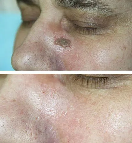 Ceboreyny keratosis (ctarcheskie szemölcsök) (keratosis) Ceboreyny keratosis (ctarcheskie szemölcsök)