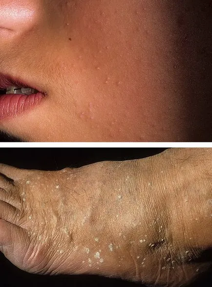 Ceboreyny keratosis (ctarcheskie szemölcsök) (keratosis) Ceboreyny keratosis (ctarcheskie szemölcsök)