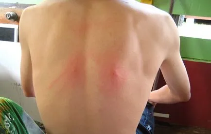 A kenet szúnyogcsípés - felülvizsgálata hatásos eszközök (kenet) A kenet szúnyogcsípés - felülvizsgálata hatékony jogorvoslat