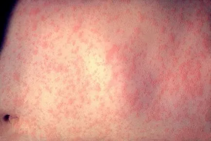 Mint kezelni foltok a testen piros - fotó és leírás a fajta foltok, allergiák, betegségek