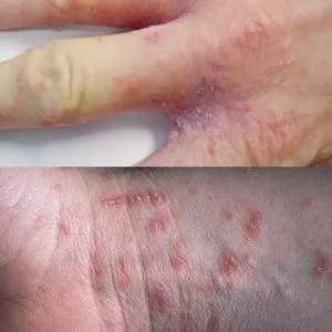 Rüh tünetek, fotó, korai jelei felnőttek kezelési módszerek