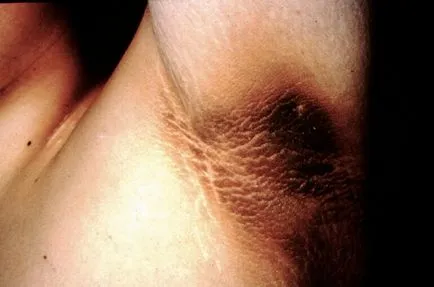 Acanthosis nigricans emberben okoz, kezelések, fotó (fekete) Acanthosis nigricans emberben okoz, kezelés, fotók