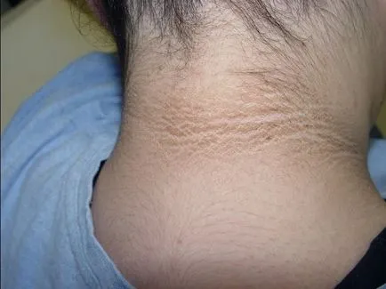 Acanthosis nigricans tünetek, kezelés