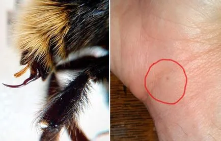 Mi a teendő, ha megharapott egy darázscsípés hatásai és az elsősegély (harapás) Mi a teendő, ha megharapott egy darázscsípés hatásai és az elsősegély