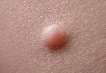 Mi papilloma, kezelése a hagyományos módszerek (a) Mi a papilloma, a kezelés a hagyományos módszerekkel
