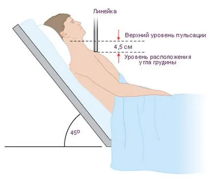 CVP (központi vénás nyomás) mértéke, mérésével, a lehetséges patológia (központi) CVP (központi vénás nyomás) aránya, mérés lehetséges patológiák