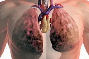 Diagnózisa pulmonális betegségek (betegségek) Diagnózisa pulmonális betegségek